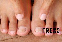 تقوس أظافر القدم الأسباب وطريقة العلاج